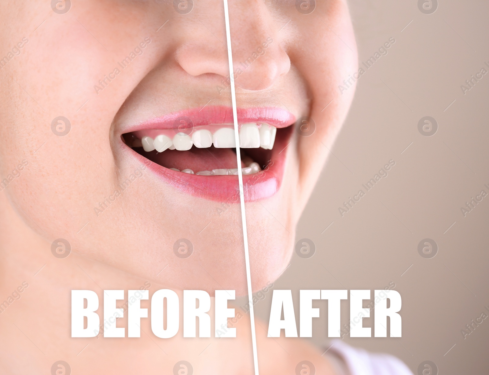 Image of Young woman before and after gingivoplasty procedure on beige background, closeup