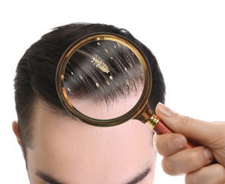 Image of Pediculosis. Man with lice and nits on white background, closeup. View through magnifying glass on hair