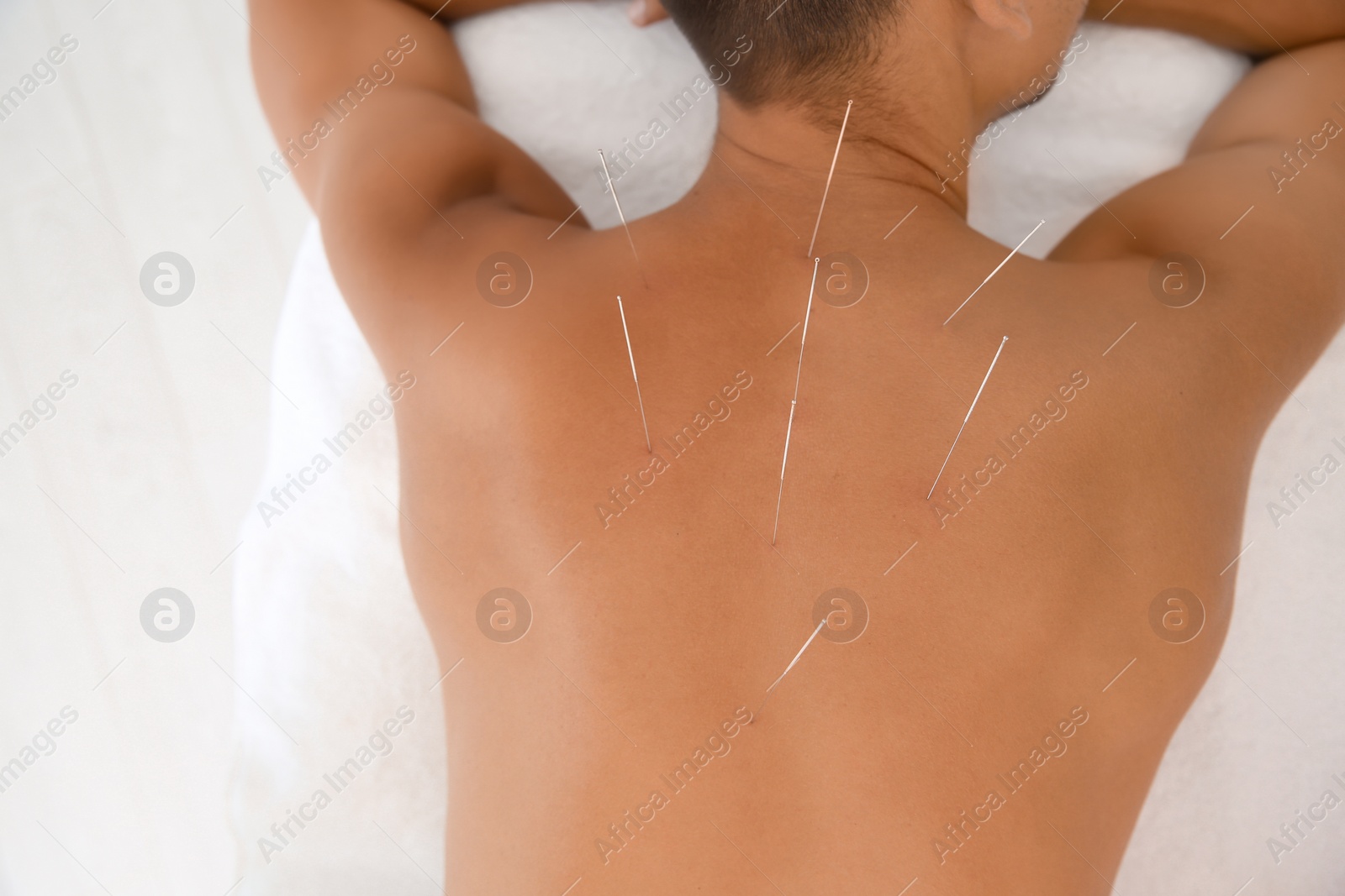 Photo of Young man undergoing acupuncture treatment in salon, closeup