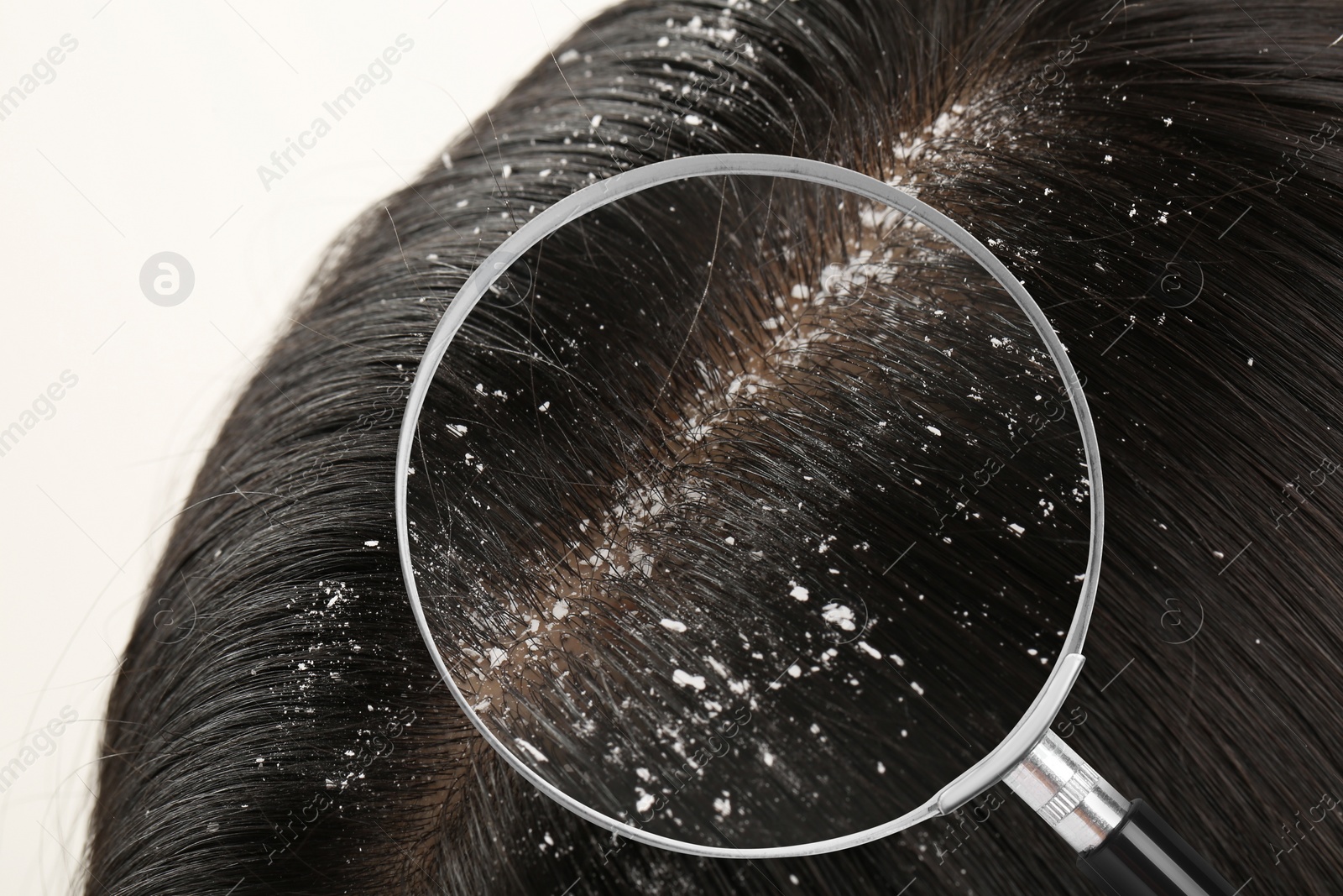 Image of Woman suffering from dandruff on white background, closeup. View through magnifying glass on hair with flakes