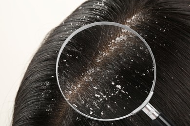 Woman suffering from dandruff on white background, closeup. View through magnifying glass on hair with flakes