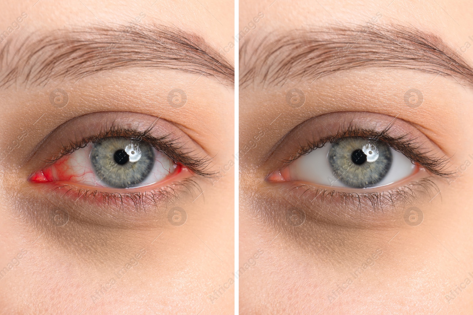 Image of Collage with photos of woman before and after conjunctivitis treatment, closeup of eye