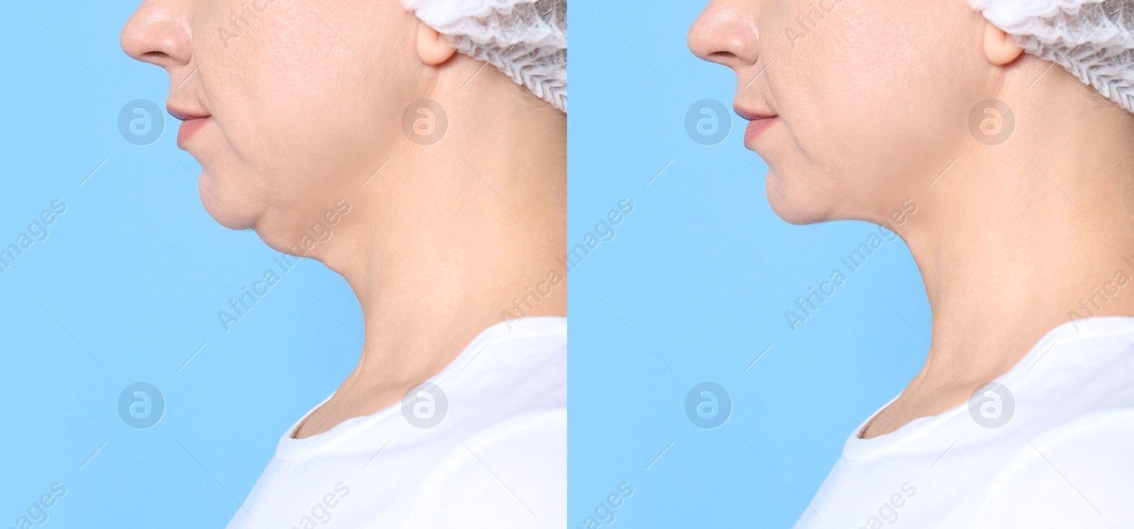 Image of Mature woman before and after plastic surgery operation on blue background, closeup. Double chin problem