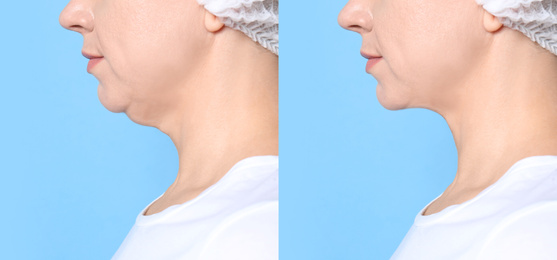 Mature woman before and after plastic surgery operation on blue background, closeup. Double chin problem