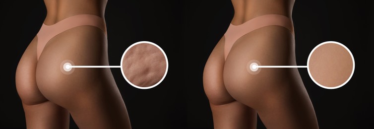 Before and after cellulite treatment, zoomed smooth and dimpled skin. Collage with photos of slim woman in underwear on black background, closeup