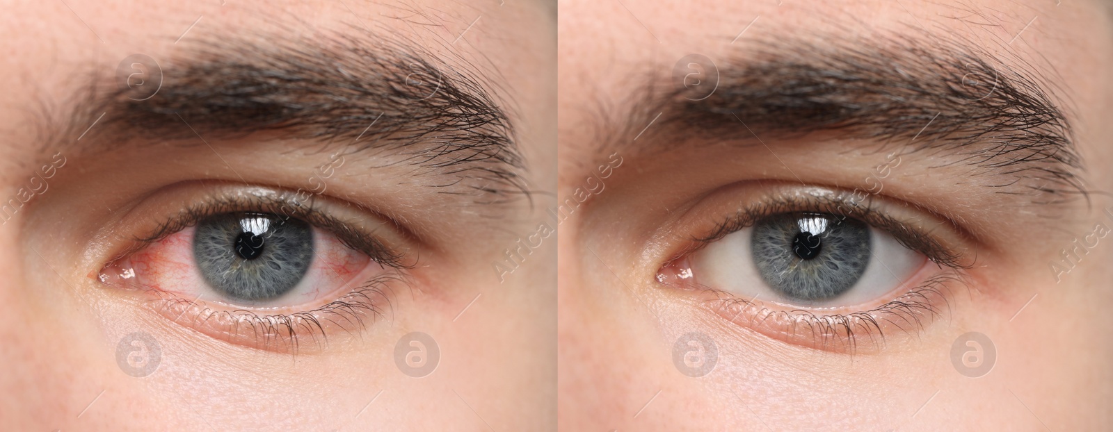 Image of Collage with photos of man with inflamed and healthy eyes before and after treatment, closeup. Banner design