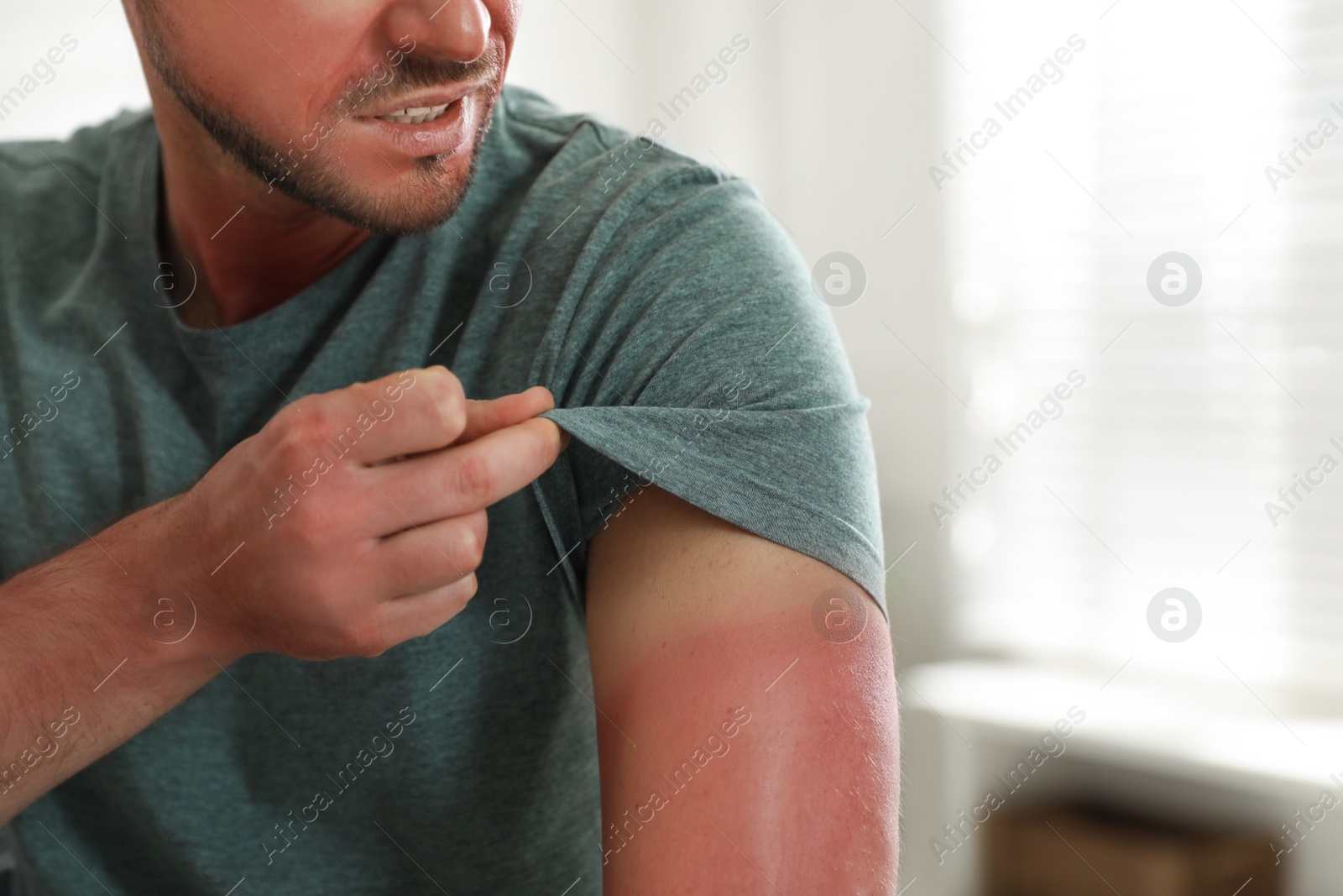 Photo of Man with sunburned skin at home, closeup