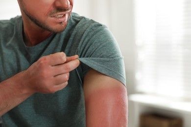 Photo of Man with sunburned skin at home, closeup