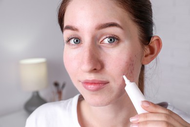 Photo of Woman with acne problem applying cream at home