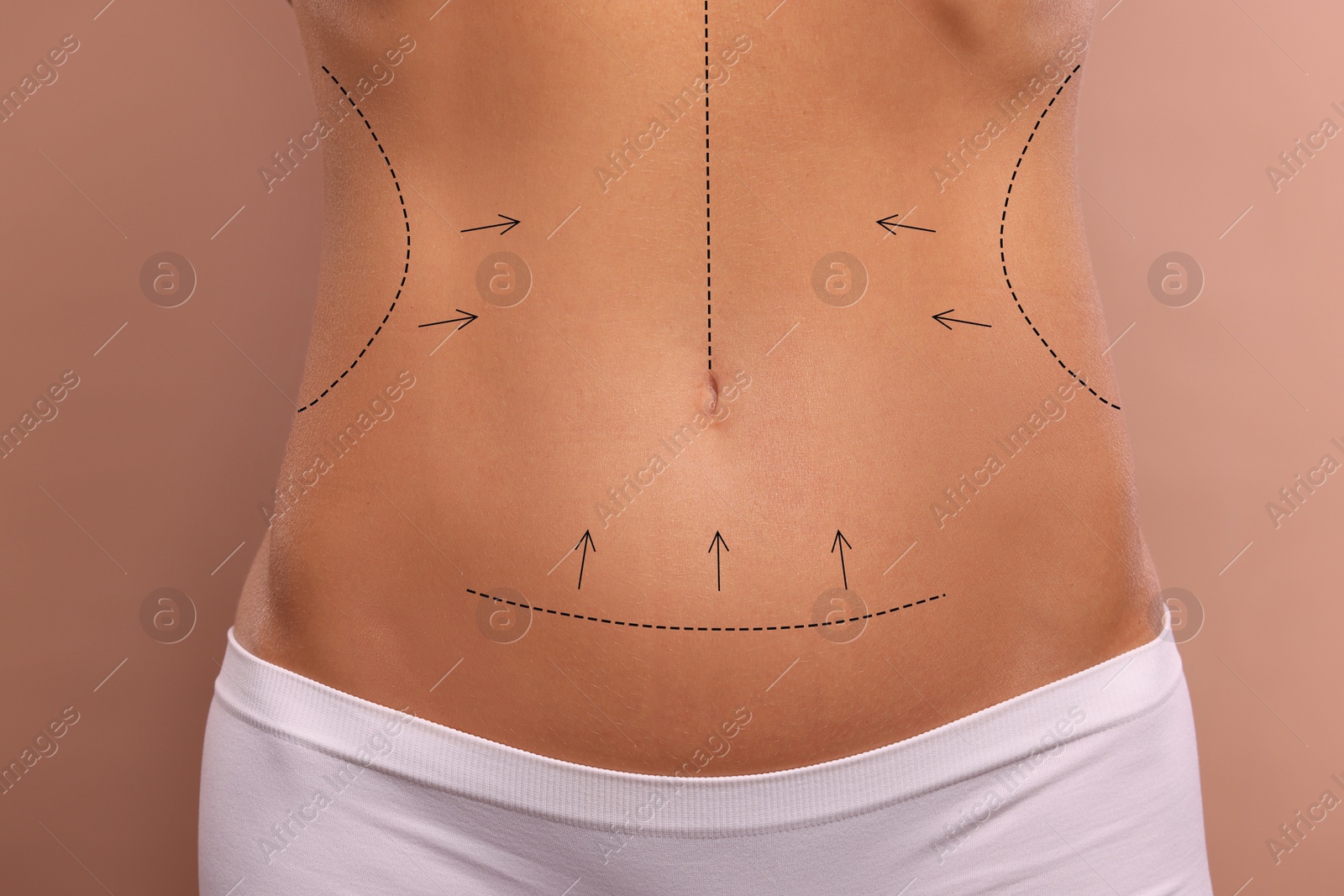 Image of Woman with markings for cosmetic surgery on her abdomen against light brown background, closeup