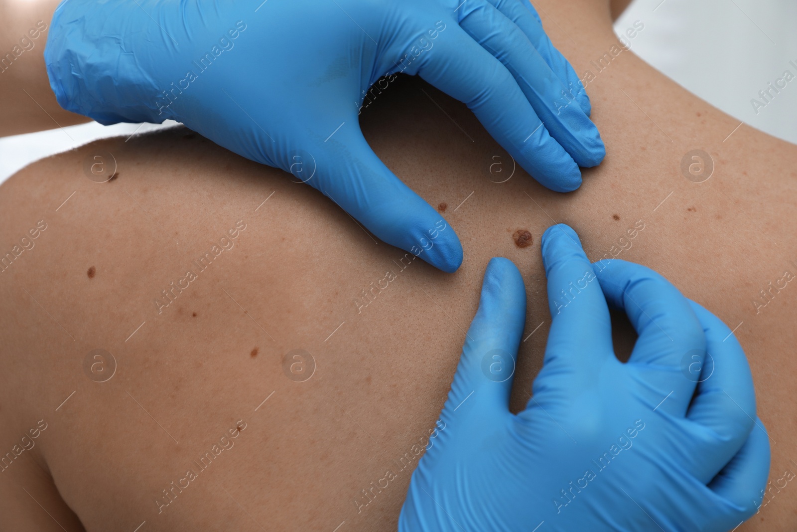 Photo of Dermatologist examining patient's birthmark in clinic, closeup view