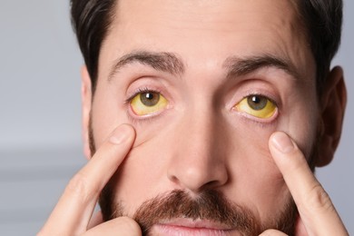 Photo of Man with yellow eyes on blurred background, closeup. Symptom of hepatitis