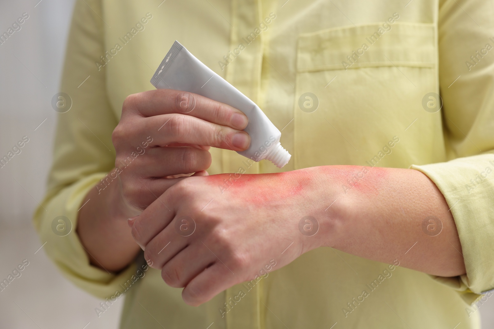 Photo of Woman applying healing cream onto burned hand indoors, closeup