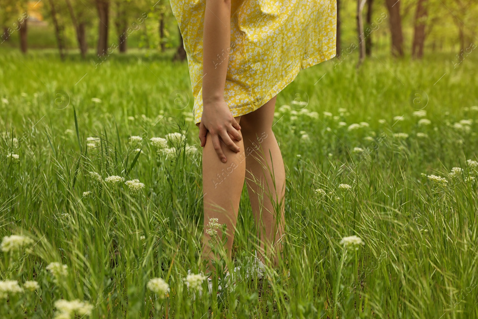 Photo of Young woman scratching leg outdoors, closeup. Seasonal allergy