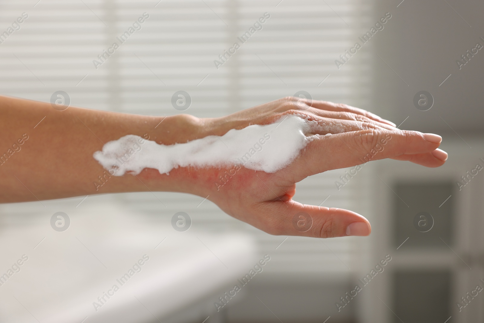 Photo of Woman with panthenol on her burned hand indoors, closeup