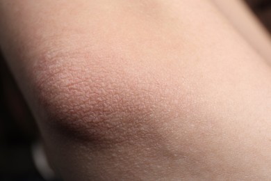 Photo of Woman with dry skin on elbow, closeup