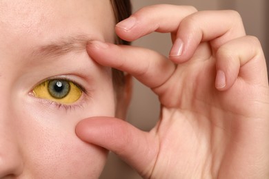 Woman with yellow eyes on blurred background, closeup. Symptom of hepatitis