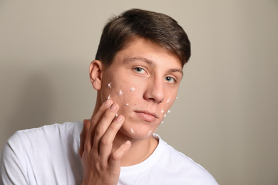 Photo of Teen guy with acne problem applying cream on beige background