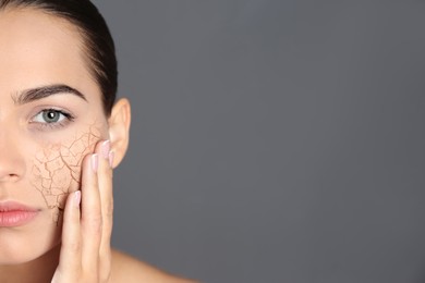 Image of Beautiful young woman with dry skin on grey background, closeup. Space for text