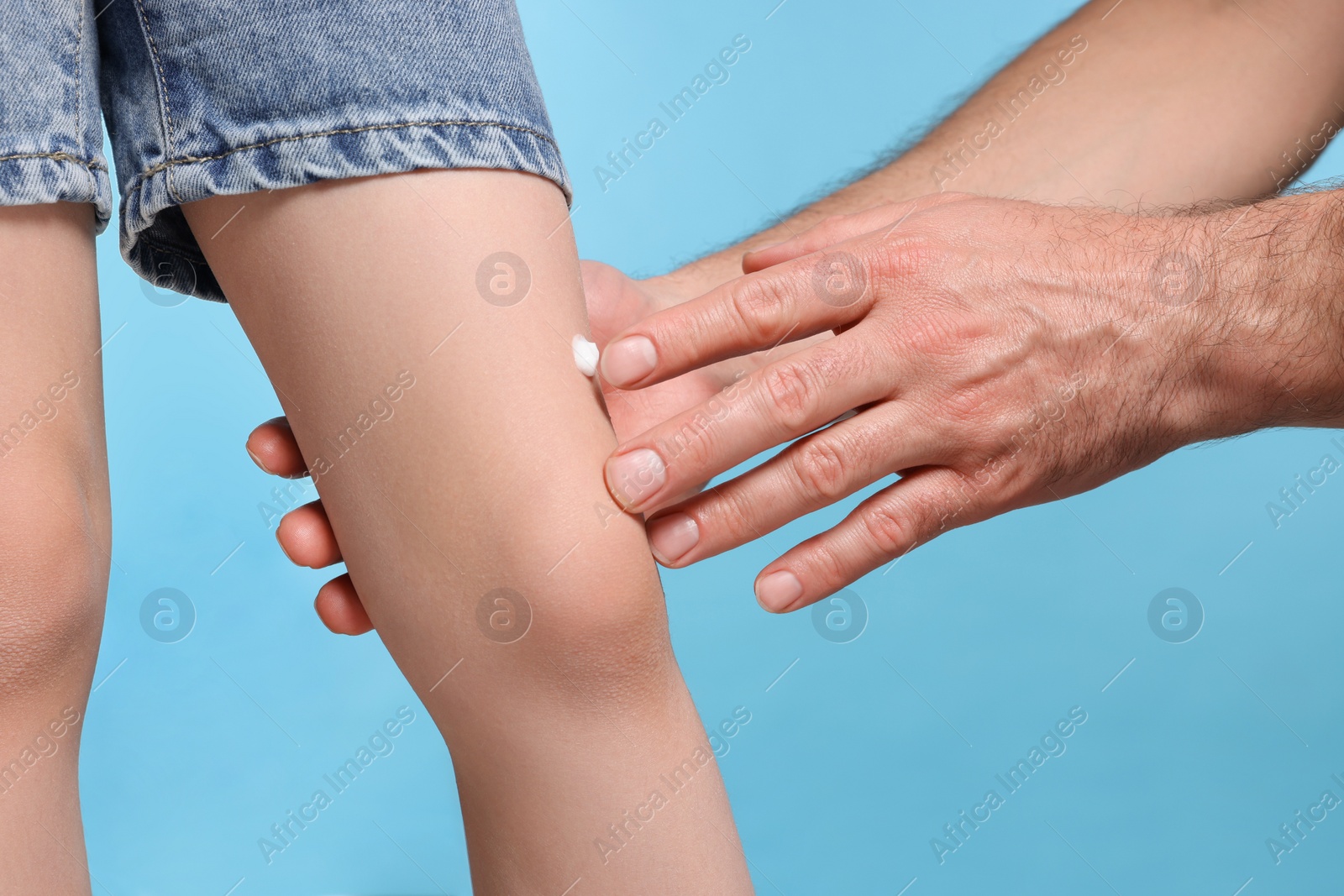 Photo of Father applying ointment onto his daughter's leg on light blue background, closeup