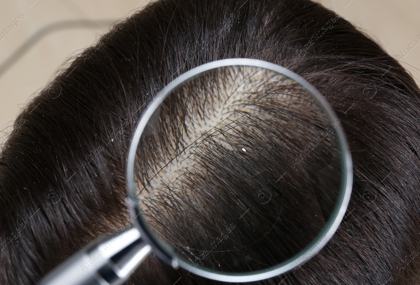 Photo of Closeup of woman with dandruff in her hair, view through magnifying glass