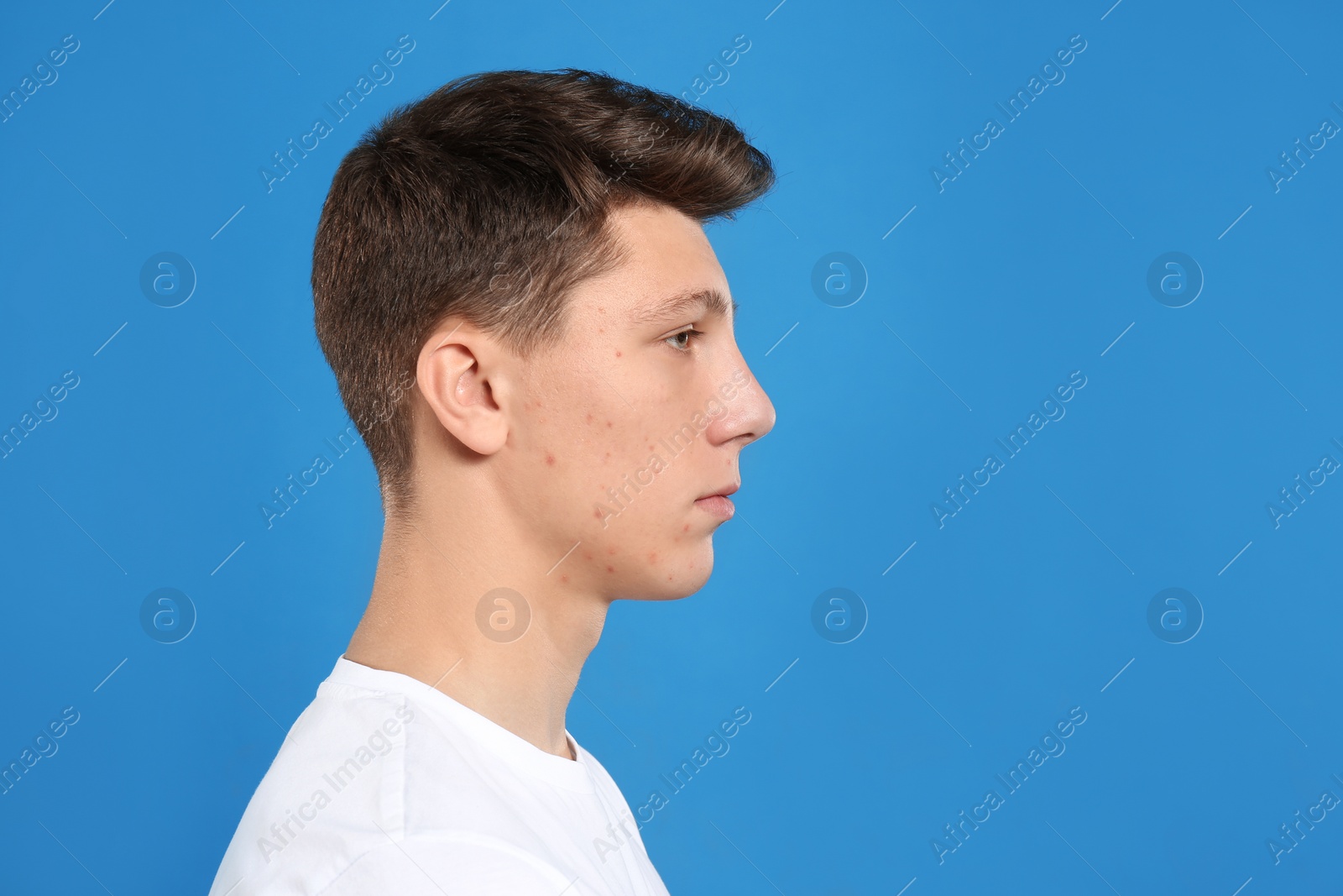 Photo of Teen guy with acne problem on blue background. Space for text