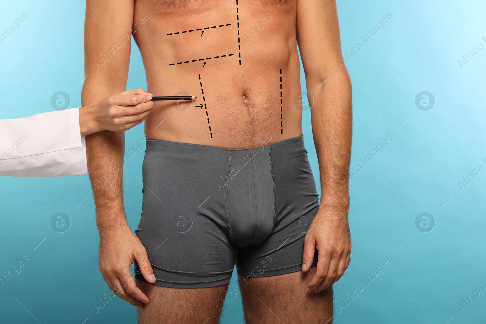 Image of Man preparing for cosmetic surgery, light blue background. Doctor drawing markings on his abdomen, closeup