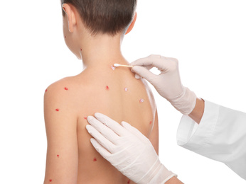 Photo of Doctor applying cream onto skin of little boy with chickenpox on white background, closeup. Varicella zoster virus