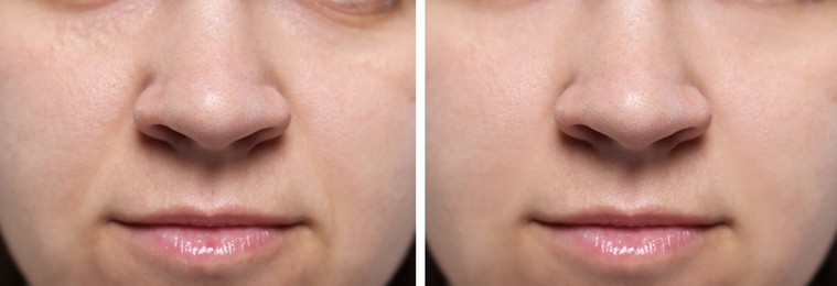 Aging skin changes. Woman showing face before and after rejuvenation, closeup. Collage comparing skin condition