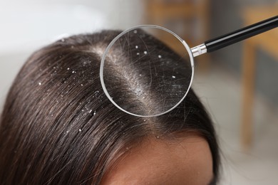 Woman suffering from dandruff on blurred background, closeup. View through magnifying glass on hair with flakes