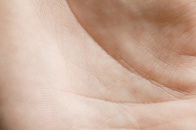 Photo of Closeup view of human hand with dry skin