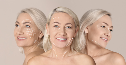 Image of Photos of mature woman with lifting marks on face against beige background, collage. Cosmetic surgery