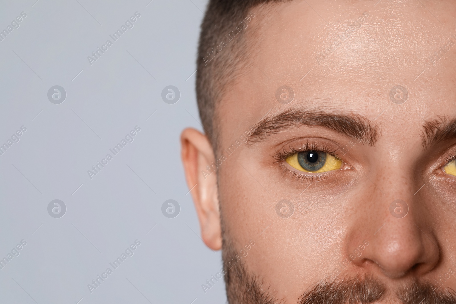 Photo of Man with yellow eyes on light grey background, closeup and space for text. Hepatitis symptom