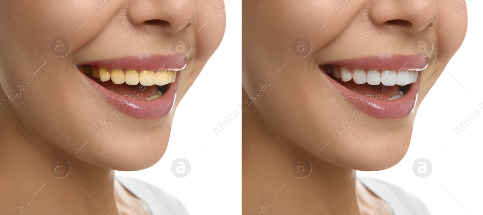 Image of Collage with photos of woman before and after tooth whitening on white background, closeup