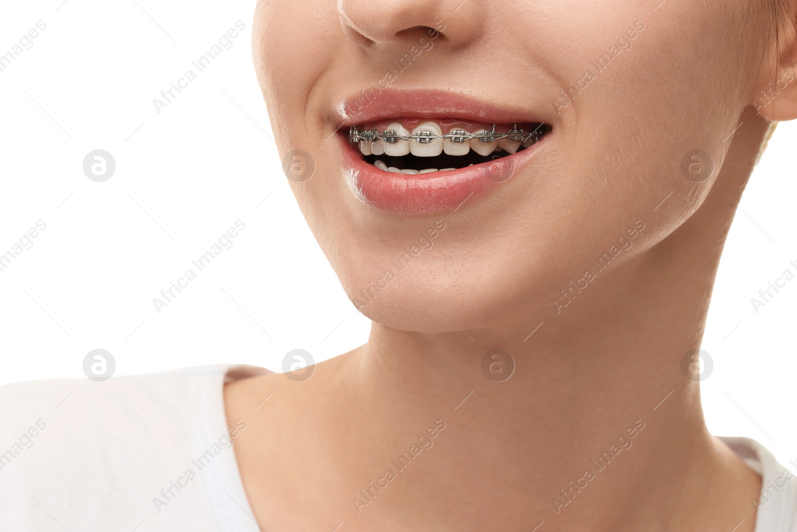 Photo of Smiling woman with dental braces on white background, closeup