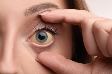 Woman with yellow eyes, closeup. Liver problems symptom