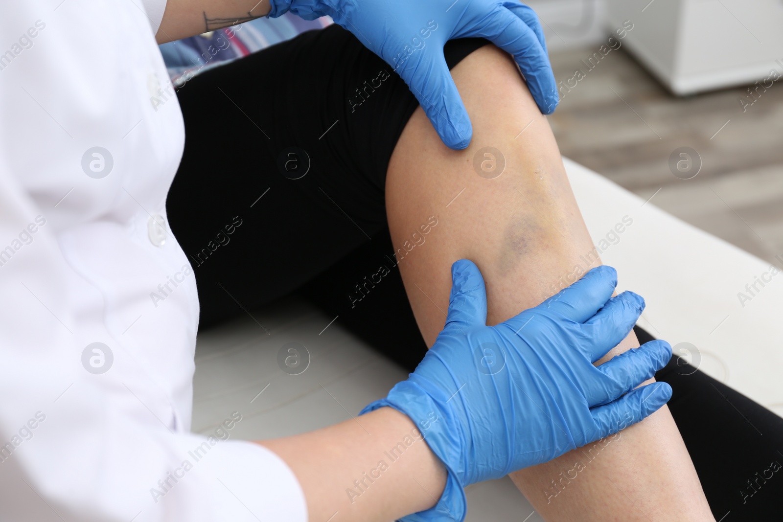 Photo of Doctor checking boy's leg with bruise at hospital, closeup