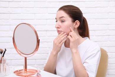 Woman with acne problem looking at mirror indoors