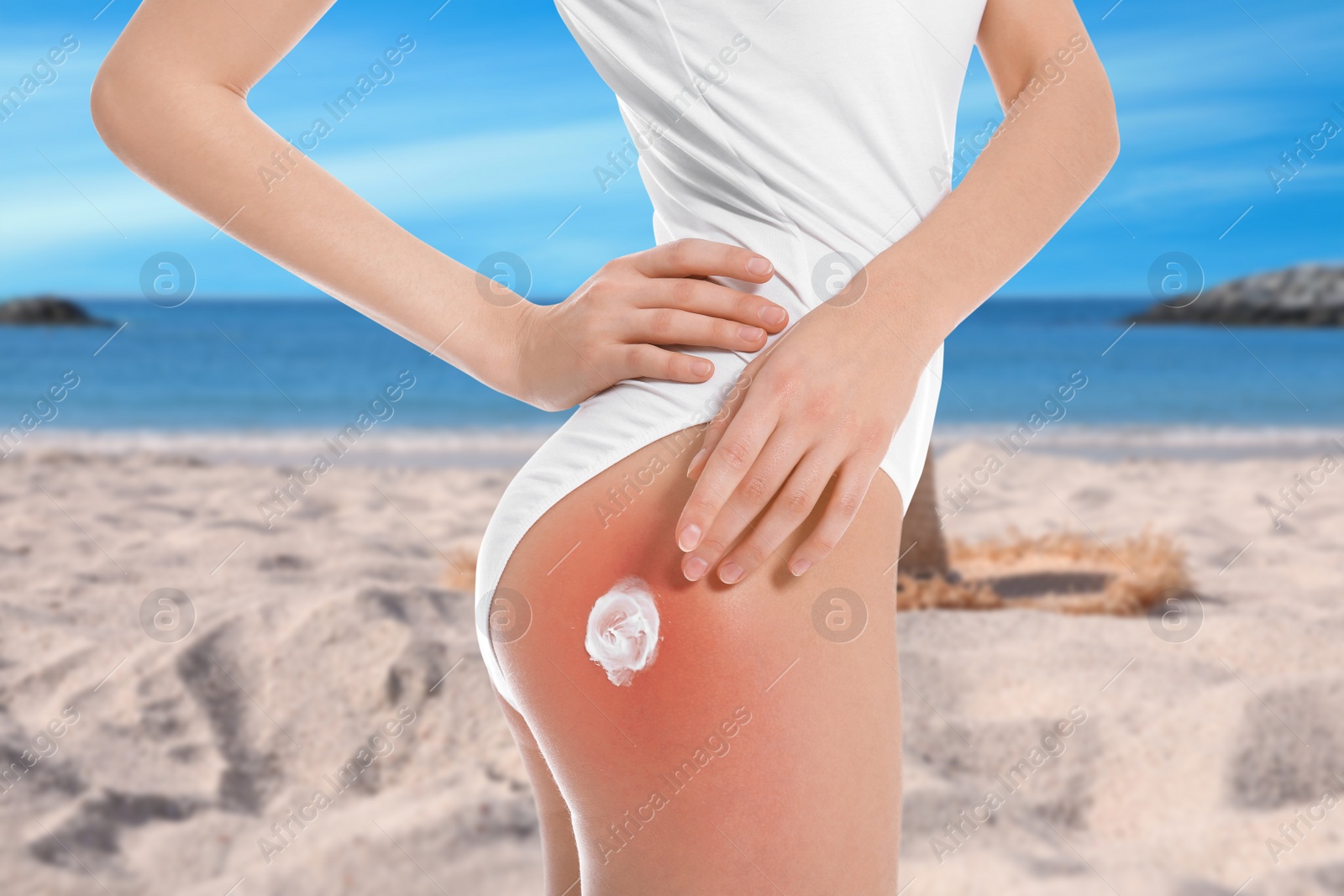 Image of Woman with sunburn on beach, closeup. Skin protection from sun in summer