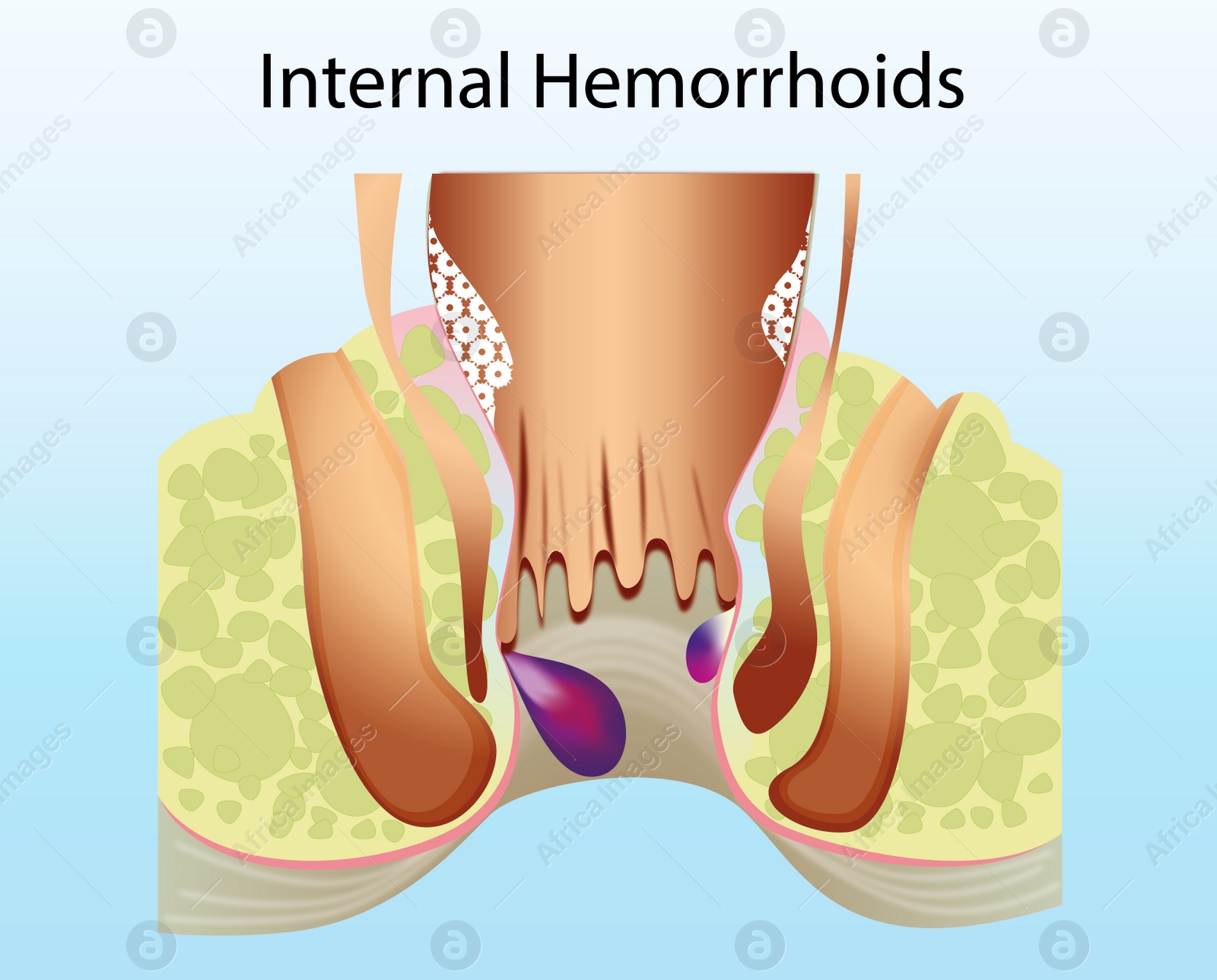 Image of Internal hemorrhoid. Unhealthy lower rectum with inflamed vascular structures, illustration