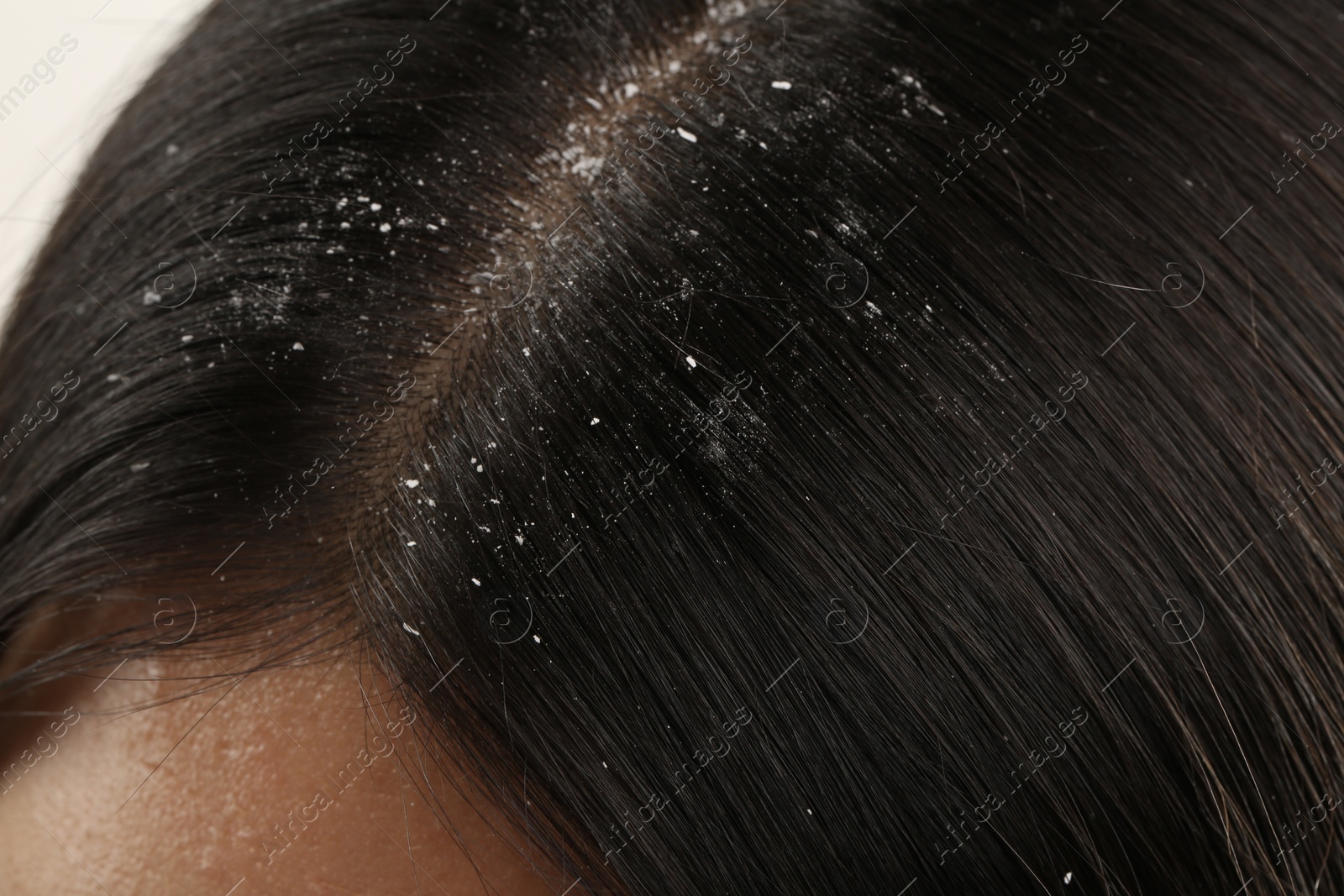 Photo of Woman with dandruff in her dark hair on white background, closeup