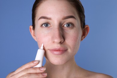 Photo of Young woman with acne problem applying cosmetic product onto her skin on blue background, closeup