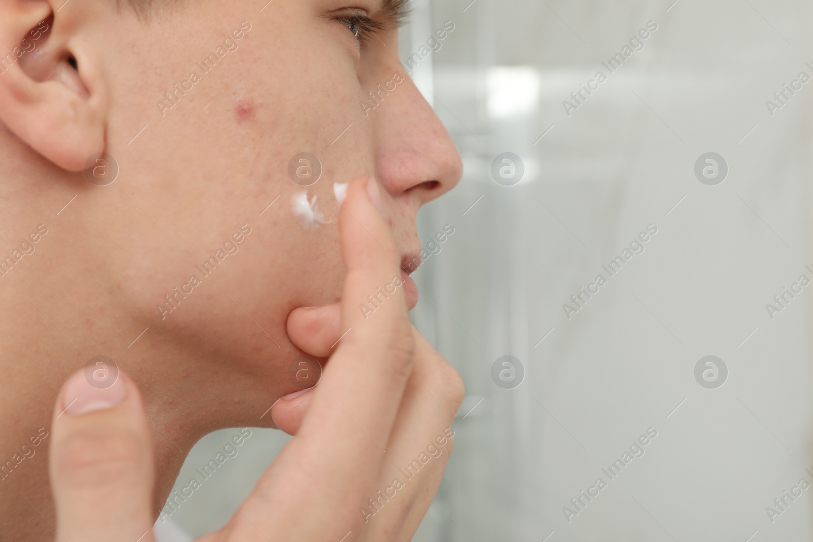 Photo of Teen guy with acne problem applying cream indoors, closeup