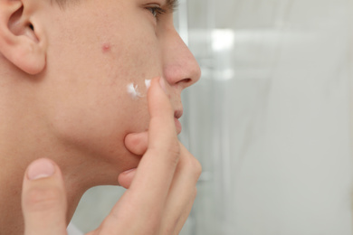 Photo of Teen guy with acne problem applying cream indoors, closeup