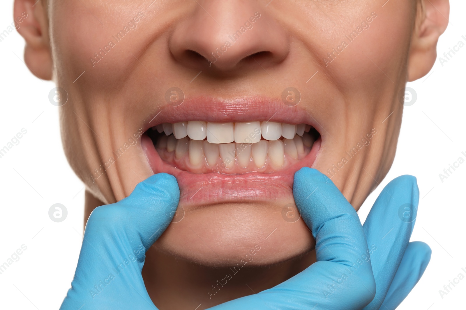 Photo of Doctor examining woman's gums on white background, closeup
