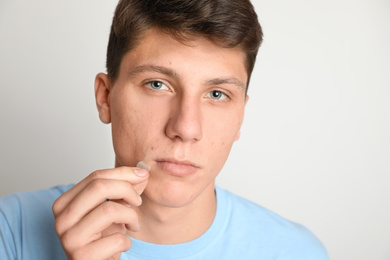 Teen guy applying acne healing patch on light background
