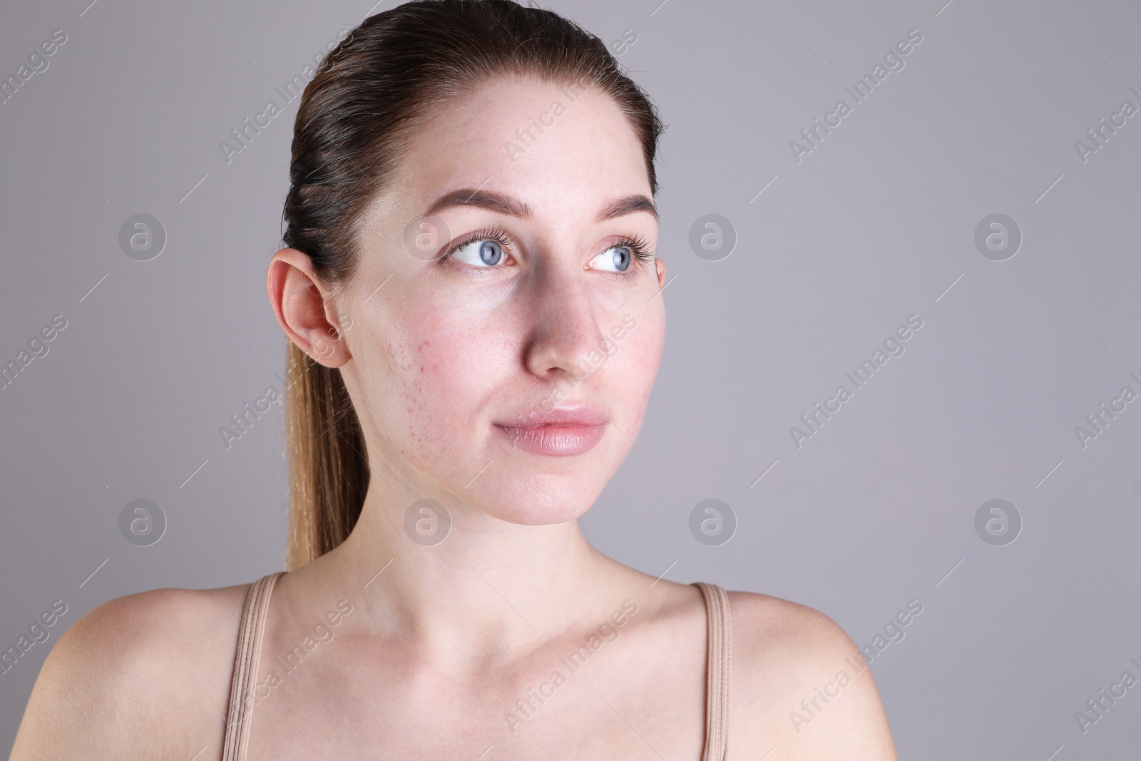 Photo of Young woman with acne problem on light grey background. Space for text