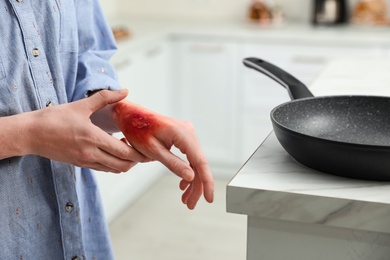 Photo of Woman with burn on her hand in kitchen, closeup