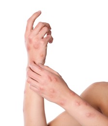Photo of Woman with rash suffering from monkeypox virus on white background, closeup