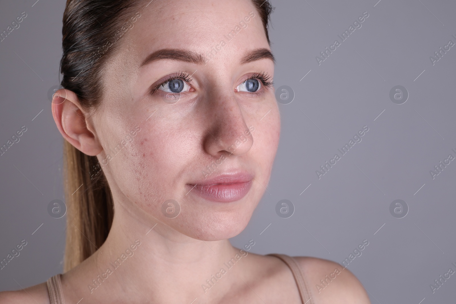 Photo of Young woman with acne problem on light grey background. Space for text